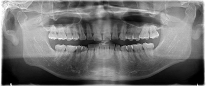 歯のレントゲン写真